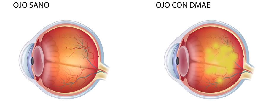 enfermedades maculares