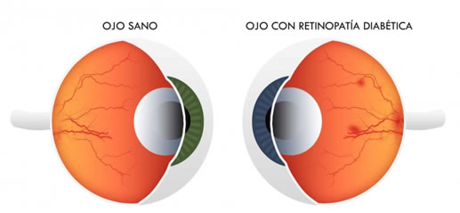 enfermedades maculares